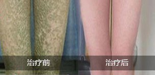 遺傳性魚鱗病吃什么藥，參歸潤(rùn)燥搽劑效果怎么樣