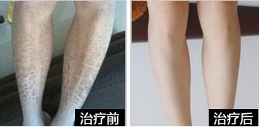魚鱗皮膚病的治療方法，參歸潤燥搽劑好嗎
