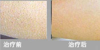 參歸潤燥擦劑，魚鱗皮膚病如何治療