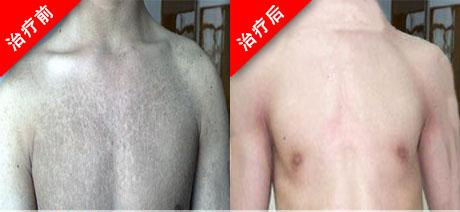 遺傳魚鱗病吃什么藥，參歸潤燥搽劑怎么樣