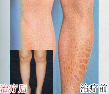 遺傳性魚鱗病吃什么藥，吃什么藥能治魚鱗病